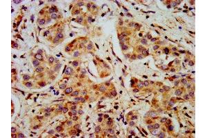IHC image of ABIN7169467 diluted at 1:400 and staining in paraffin-embedded human liver cancer performed on a Leica BondTM system. (SHANK2 antibody  (AA 728-822))