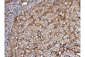 IHC-P Image Apolipoprotein E antibody detects Apolipoprotein E protein at secreted on human hepatoma by immunohistochemical analysis.