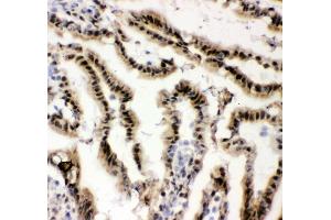 IHC analysis of EWSR1 using anti-EWSR1 antibody (ABIN3043825). (EWSR1 antibody  (Middle Region))