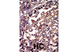 Formalin-fixed and paraffin-embedded human hepatocellular carcinoma tissue reacted with PRKAR1A polyclonal antibody  , which was peroxidase-conjugated to the secondary antibody, followed by AEC staining. (PRKAR1A antibody  (N-Term))
