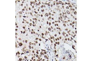 Immunohistochemistry of paraffin-embedded human breast cancer using PSME3 Rabbit pAb (ABIN6135015, ABIN6146357, ABIN6146358 and ABIN6216428) at dilution of 1:100 (40x lens). (PSME3 antibody  (C-Term))