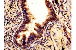 IHC image of ABIN7168493 diluted at 1:600 and staining in paraffin-embedded human lung cancer performed on a Leica BondTM system. (RUVBL1 antibody  (AA 101-400))