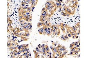 Immunohistochemistry analysis of paraffin-embedded human liver cancer using CD107b Polyclonal Antibody at dilution of 1:300. (LAMP2 antibody)