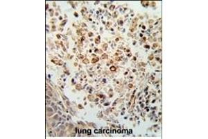 Formalin-fixed and paraffin-embedded human lung carcinoma reacted with FPRL2 Antibody (Center), which was peroxidase-conjugated to the secondary antibody, followed by DAB staining.