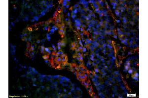 Formalin-fixed and paraffin embedded human lung carcinoma labeled with Anti-CD8 Polyclonal Antibody, Unconjugated (ABIN1385272) at 1:200 followed by secondary antibody was Goat Anti-Rabbit IgG, Cy3 conjugated used at 1:200 (CD8 antibody  (AA 51-150))