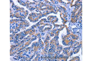 Immunohistochemistry of Human thyroid cancer using IGSF10 Polyclonal Antibody at dilution of 1:60 (IGSF10 antibody)