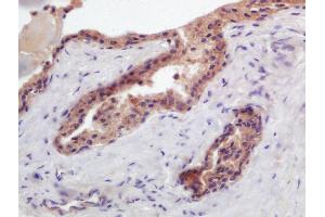 Formalin-fixed and paraffin embedded human prostate carcinoma labeled with Anti-PTGFR Polyclonal Antibody, Unconjugated (ABIN2178742) at 1:200 followed by conjugation to the secondary antibody and DAB staining (PTGFR antibody  (AA 121-220))