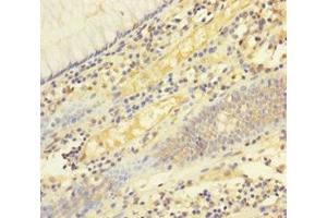 Immunohistochemistry of paraffin-embedded human colon cancer using ABIN7173813 at dilution of 1:100 (FASL antibody  (AA 103-281))