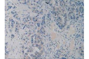 IHC-P analysis of Human Breast Cancer Tissue, with DAB staining. (PACAP antibody  (AA 17-176))