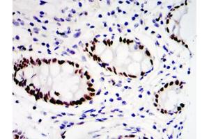Immunohistochemical analysis of paraffin-embedded colon cancer tissues (ETV4 antibody  (Internal Region))