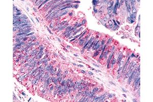 Anti-CELSR3 antibody IHC of human Colon, Carcinoma. (CELSR3 antibody  (N-Term))