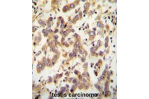 CT173 antibody (Center) immunohistochemistry analysis in formalin fixed and paraffin embedded human testis carcinoma followed by peroxidase conjugation of the secondary antibody and DAB staining. (C20ORF173 antibody  (Middle Region))