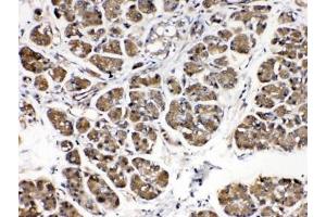IHC testing of human pancreatic cancer tissue with Alpha Amylase antibody at 0.