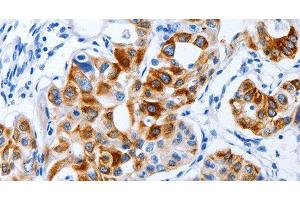 Immunohistochemistry of paraffin-embedded Human lung cancer using BPIFB3 Polyclonal Antibody at dilution of 1:120 (BPIFB3 antibody)