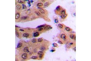 Immunohistochemical analysis of c-FOS (pS362) staining in human lung cancer formalin fixed paraffin embedded tissue section. (c-FOS antibody  (C-Term, pSer362))