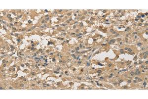 Immunohistochemistry of paraffin-embedded Human thyroid cancer using ALDH8A1 Polyclonal Antibody at dilution of 1:30 (ALDH8A1 antibody)