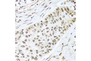 Immunohistochemistry of paraffin-embedded human lung cancer using PGR antibody. (Progesterone Receptor antibody)
