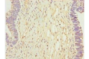 Immunohistochemistry of paraffin-embedded human ovarian cancer using ABIN7146349 at dilution of 1:100 (CALCOCO2 antibody  (AA 137-446))