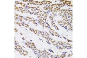 Immunohistochemistry of paraffin-embedded human breast cancer using HDGF Antibody.