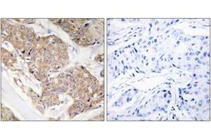 Immunohistochemistry analysis of paraffin-embedded human breast carcinoma tissue, using IL-13R/CD213 alpha1 (Ab-405) Antibody. (CD213alpha1 (AA 371-420) antibody)