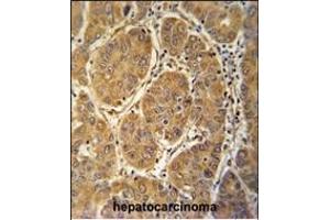 MCEE antibody (C-term) (ABIN653998 and ABIN2843935) immunohistochemistry analysis in formalin fixed and paraffin embedded human hepatocarcinoma followed by peroxidase conjugation of the secondary antibody and DAB staining. (MCEE antibody  (C-Term))