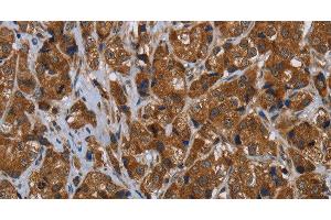 Immunohistochemistry of paraffin-embedded Human breast cancer tissue using ARHGEF12 Polyclonal Antibody at dilution 1:30 (ARHGEF12 antibody)