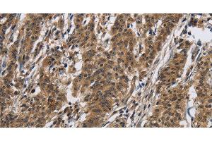 Immunohistochemistry of paraffin-embedded Human gasrtic cancer tissue using IL12RB2 Polyclonal Antibody at dilution 1:40 (IL12RB2 antibody)