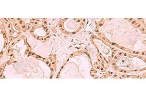 Immunohistochemistry of paraffin-embedded Human thyroid cancer tissue using SETDB1 Polyclonal Antibody at dilution of 1:60(x200) (SETDB1 antibody)