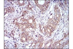 Immunohistochemical analysis of paraffin-embedded cervical cancer tissues using EPCAM mouse mAb with DAB staining. (EpCAM antibody  (AA 24-265))