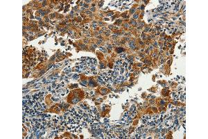 Immunohistochemistry of Human lung cancer using SERPINA9 Polyclonal Antibody at dilution of 1:60