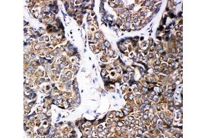 IHC-P: ABCB6 antibody testing of human breast cancer tissue (ABCB6 antibody  (C-Term))