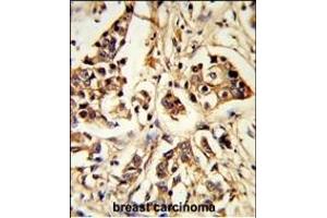 Formalin-fixed and paraffin-embedded human breast carcinoma reacted with ARHG Antibody (Center), which was peroxidase-conjugated to the secondary antibody, followed by DAB staining. (ARHGAP18 antibody  (AA 180-207))