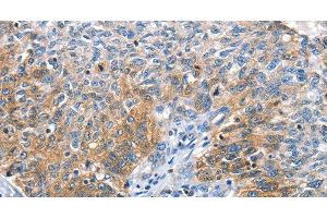 Immunohistochemistry of paraffin-embedded Human ovarian cancer tissue using CGB Polyclonal Antibody at dilution 1:60 (CGB antibody)