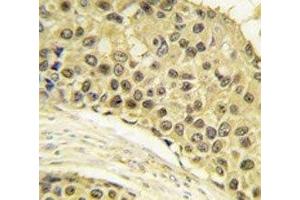 IHC analysis of FFPE human breast carcinoma tissue stained with Cyclin A2 antibody (Cyclin A antibody  (AA 358-389))