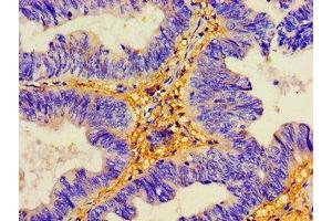 Immunohistochemistry of paraffin-embedded human colon cancer using ABIN7149779 at dilution of 1:100 (Desmoglein 2 antibody  (AA 183-331))