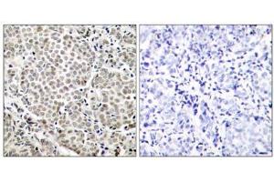Immunohistochemical analysis of paraffin-embedded human breast carcinoma tissue, using NF-κB p65 (Phospho-Ser529) antibody (E011217). (NF-kB p65 antibody  (pSer529))