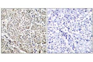 Immunohistochemical analysis of paraffin-embedded human breast carcinoma tissue, using NF-κB p65 (Phospho-Ser529) antibody (E011217). (NF-kB p65 antibody  (pSer529))
