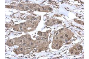 IHC-P Image Immunohistochemical analysis of paraffin-embedded human breast cancer, using VCP, antibody at 1:500 dilution. (VCP antibody  (C-Term))