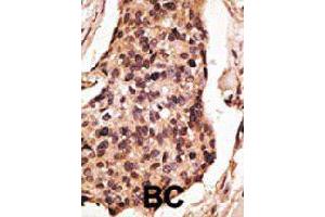 Formalin-fixed and paraffin-embedded human cancer tissue reacted with the SIGLEC8 polyclonal antibody  , which was peroxidase-conjugated to the secondary antibody, followed by DAB staining. (SIGLEC8 antibody  (C-Term))