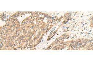 Immunohistochemistry of paraffin-embedded Human liver cancer tissue using IMPA1 Polyclonal Antibody at dilution of 1:25(x200) (IMPA1 antibody)
