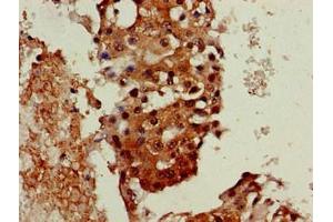 Immunohistochemistry of paraffin-embedded human breast cancer using ABIN7161445 at dilution of 1:100 (Neuroserpin antibody  (AA 191-240))
