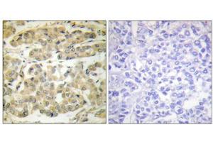 Immunohistochemical analysis of paraffin-embedded human breast carcinoma tissue, using 14-3-3 zeta (phospho-Ser58) antibody. (14-3-3 zeta antibody  (pSer58))