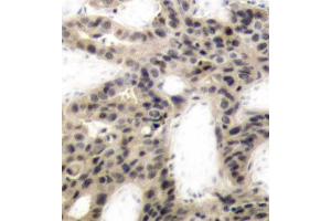 Immunohistochemistry of paraffin-embedded human breast carcinoma using Phospho-EIF4EBP1-T45 antibody (ABIN2987638). (eIF4EBP1 antibody  (pThr45))