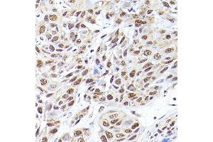 Immunohistochemistry of paraffin-embedded human esophageal cancer using SEC14L2 Rabbit pAb (ABIN6132639, ABIN6147484, ABIN6147485 and ABIN6214889) at dilution of 1:200 (40x lens). (SEC14L2 antibody  (AA 60-270))