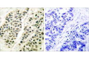 Peptide - +Immunohistochemical analysis of paraffin-embedded human breast carcinoma tissue using DNA Polymerase β antibody (#C0173). (POLB antibody)