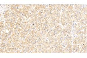 Detection of IGSF1 in Human Liver cancer Tissue using Polyclonal Antibody to Immunoglobulin superfamily, member 1 (IGSF1) (IGSF1 antibody  (AA 1008-1227))