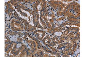 The image on the left is immunohistochemistry of paraffin-embedded Human thyroid cancer tissue using ABIN7130015(KLK13 Antibody) at dilution 1/20, on the right is treated with fusion protein. (Kallikrein 13 antibody)