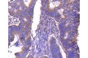 Paraformaldehyde-fixed, paraffin embedded human colon cancer, Antigen retrieval by boiling in sodium citrate buffer (pH6) for 15min, Block endogenous peroxidase by 3% hydrogen peroxide for 30 minutes, Blocking buffer at 37°C for 20min, Antibody incubation with ARF1 (1D4) Monoclonal Antibody  at 1:50 overnight at 4°C, followed by a conjugated secondary and DAB staining. (ARF1 antibody)