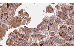 ABIN6273772 at 1/100 staining Human liver cancer tissue by IHC-P. (RIPK1 antibody  (Internal Region))