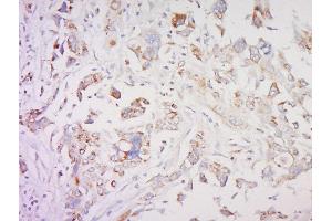 Formalin-fixed and paraffin embedded human breast cancer labeled with SMAD1 Polyclonal Antibody, Unconjugated  at 1:200 followed by conjugation to the secondary antibody and DAB staining (SMAD1 antibody  (AA 151-250))